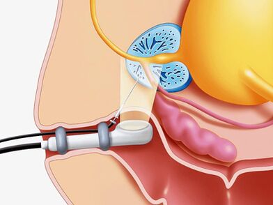 Biopsie à l'aiguille de la prostate