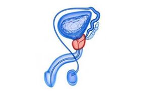 Dessin d'une inflammation de la prostate