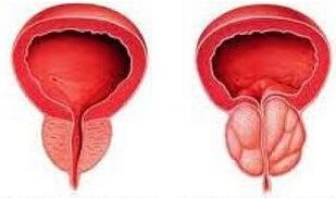 Prostate sain et enflammé